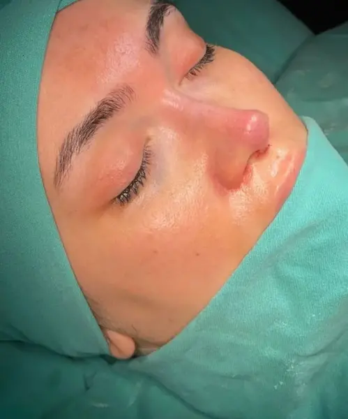 عکس برداری قبل از جراحی بینی