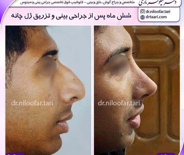 عکس برداری قبل از جراحی بینی