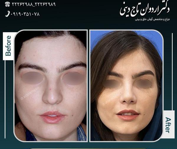 عکس برداری قبل از جراحی بینی
