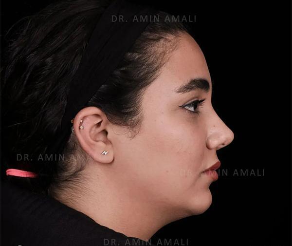 عکس برداری قبل از جراحی بینی