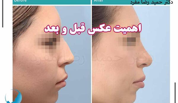 عکس برداری قبل از جراحی بینی