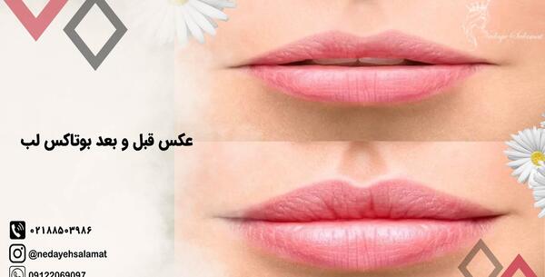 عکس قبل و بعد بوتاکس لب