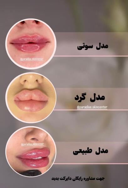 عکس قبل و بعد بوتاکس لب
