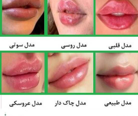 عکس قبل و بعد بوتاکس لب