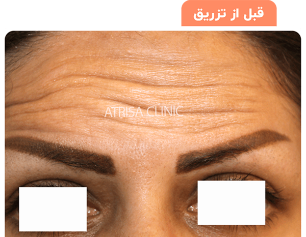 عکس قبل و بعد بوتاکس پیشانی