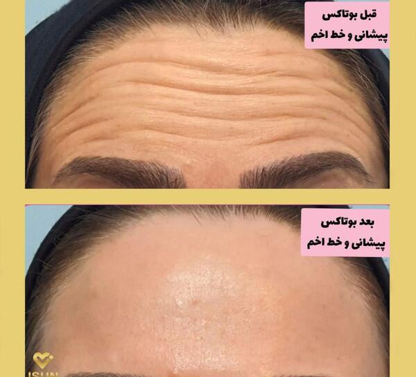 عکس قبل و بعد بوتاکس پیشانی