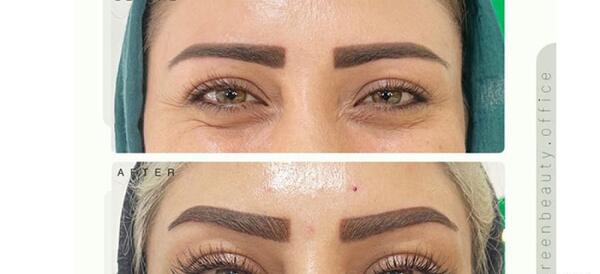 عکس قبل و بعد بوتاکس پیشانی