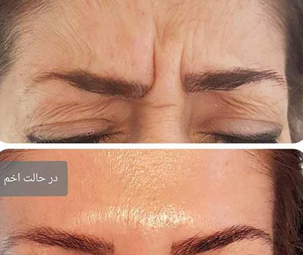 عکس قبل و بعد بوتاکس پیشانی