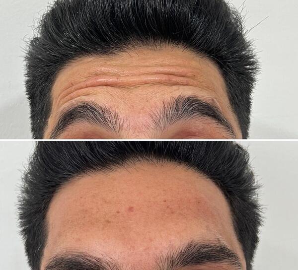 عکس قبل و بعد بوتاکس پیشانی