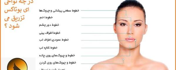 عکس قبل و بعد بوتاکس پیشانی