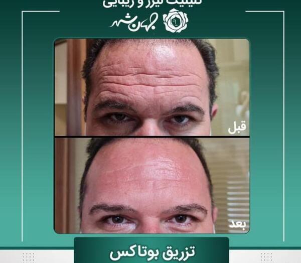 عکس قبل و بعد بوتاکس پیشانی