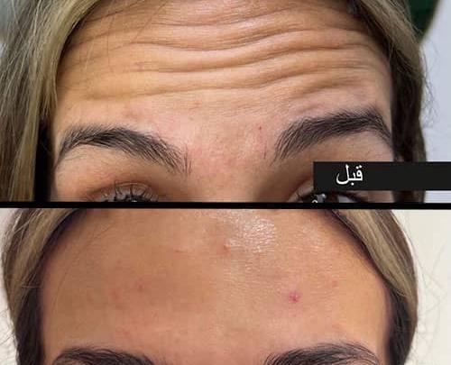 عکس قبل و بعد بوتاکس پیشانی