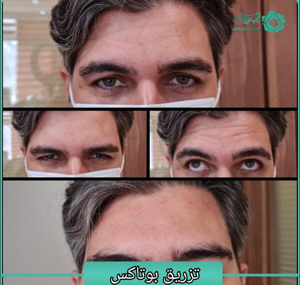 عکس قبل و بعد بوتاکس پیشانی