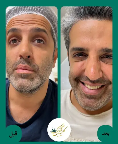 عکس قبل و بعد بوتاکس ابرو