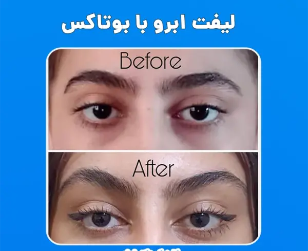 عکس قبل و بعد بوتاکس ابرو