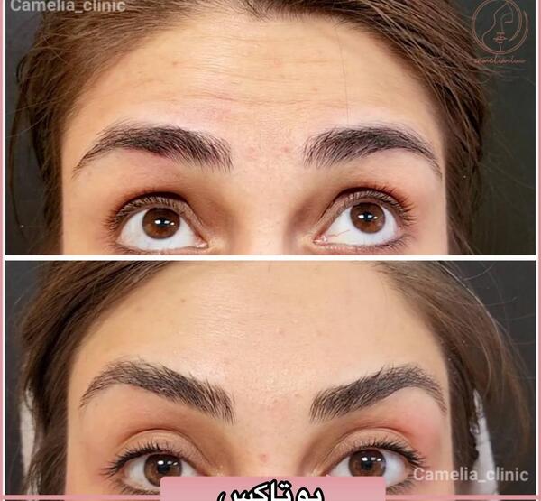 عکس قبل و بعد بوتاکس ابرو