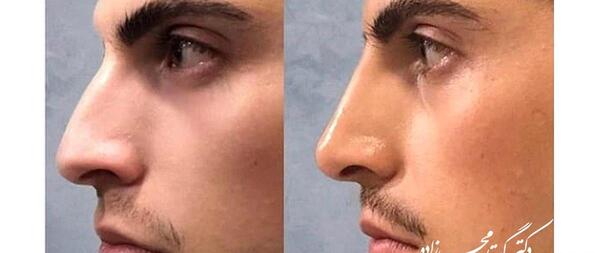 عکس قبل و بعد بوتاکس ابرو
