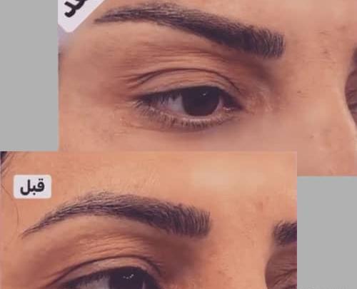 عکس قبل و بعد بوتاکس ابرو