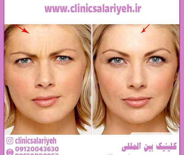 عکس قبل و بعد بوتاکس بینی