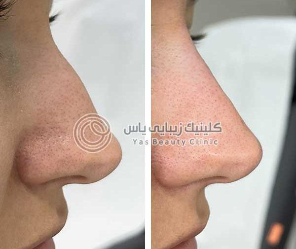 عکس قبل و بعد بوتاکس بینی