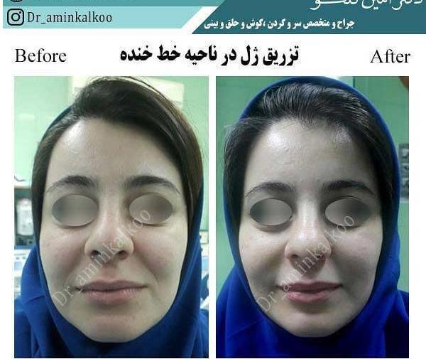 عکس قبل و بعد بوتاکس بینی