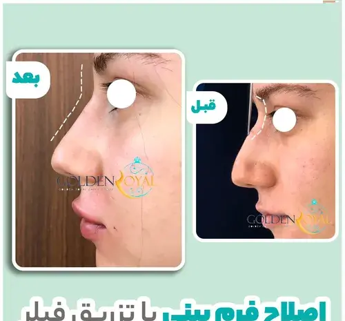 عکس قبل و بعد بوتاکس بینی