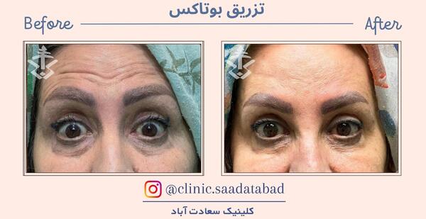 عکس قبل و بعد بوتاکس بینی