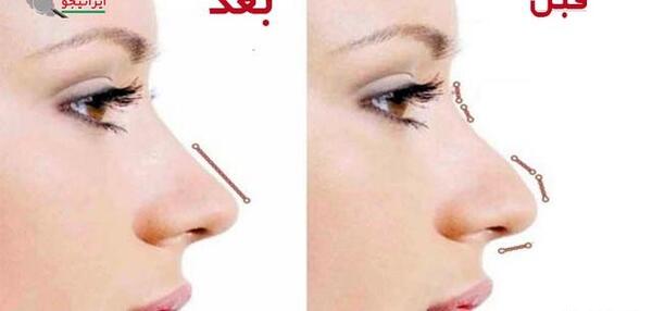 عکس قبل و بعد بوتاکس بینی