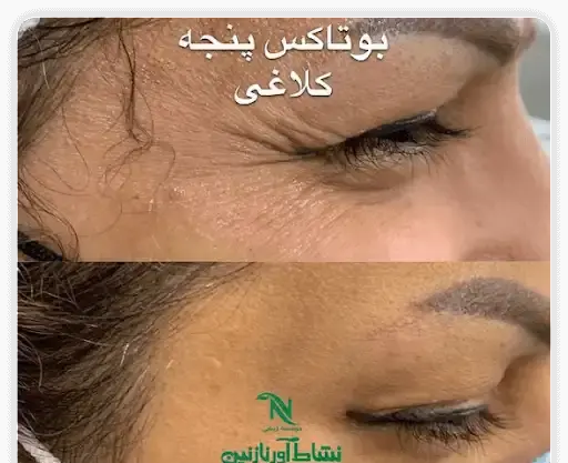 عکس قبل و بعد بوتاکس بینی