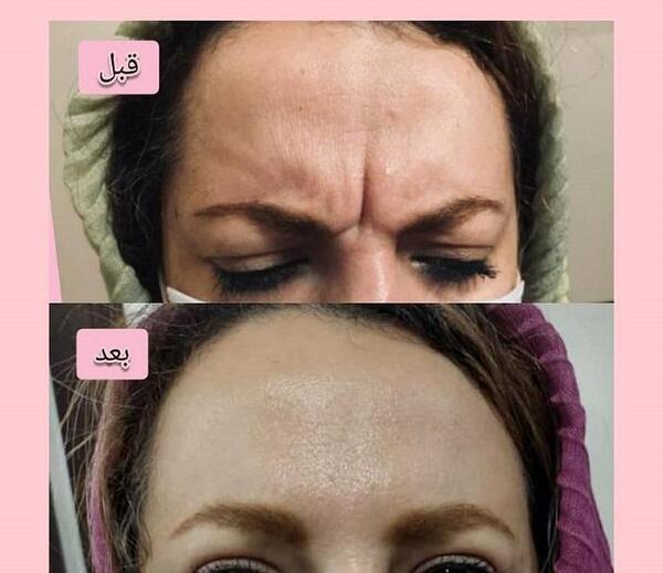 عکس قبل و بعد بوتاکس بینی