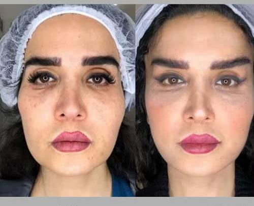 عکس قبل و بعد بوتاکس زیر چشم