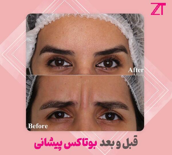 عکس قبل و بعد بوتاکس زیر چشم