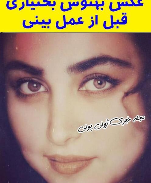عکس قبل عمل بهنوش بختیاری