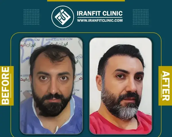 عکس احسان علیخانی قبل از عمل بینی و کاشت مو