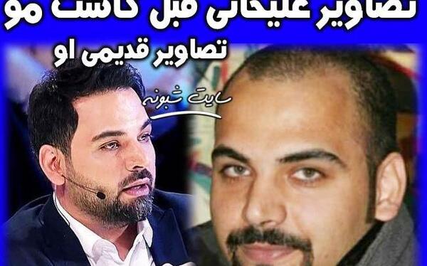 عکس احسان علیخانی قبل از عمل بینی و کاشت مو