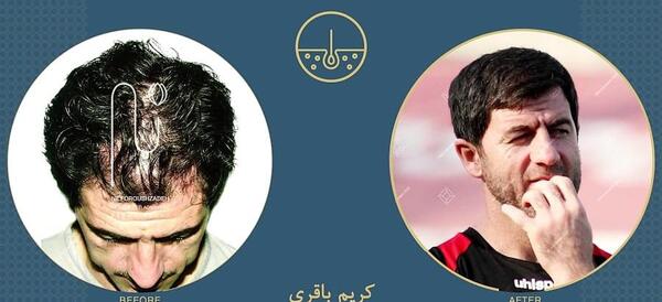 عکس احسان علیخانی قبل از عمل بینی و کاشت مو