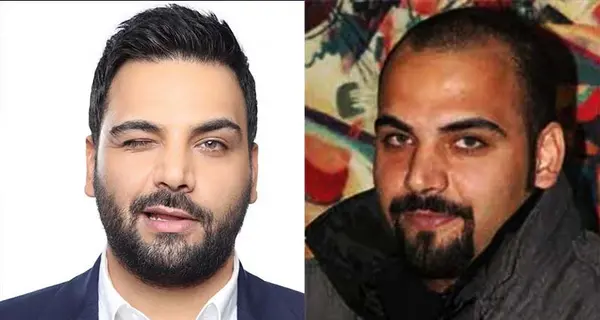عکس احسان علیخانی قبل و بعد از عمل زیبایی