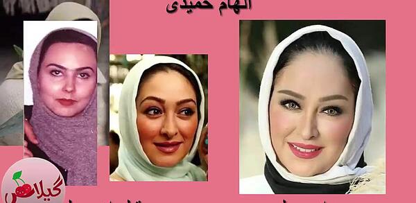 عکس احسان علیخانی قبل و بعد از عمل زیبایی
