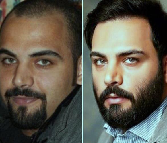 عکس احسان علیخانی قبل و بعد از عمل زیبایی