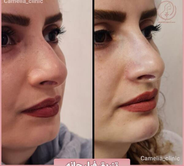عکس قبل و بعد لیزر پوست