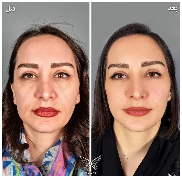 عکس قبل و بعد لیزر پوست