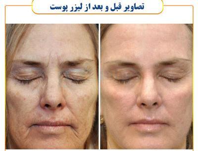 عکس قبل و بعد لیزر پوست