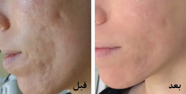 عکس قبل و بعد لیزر پوست