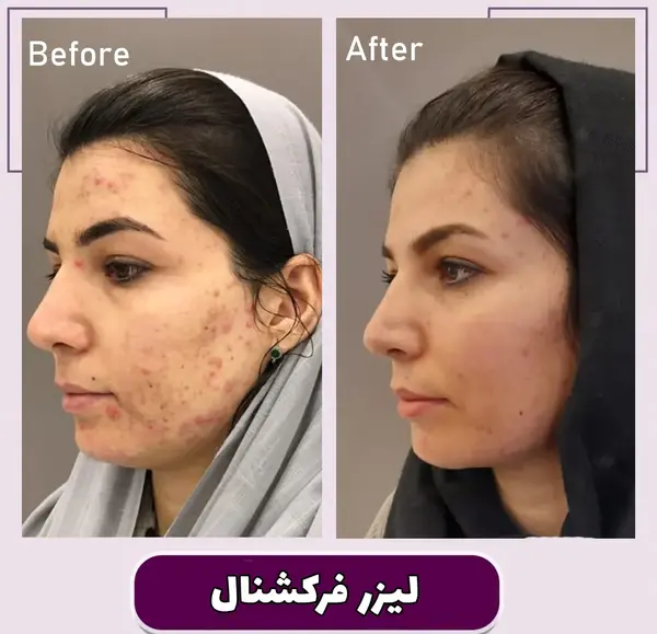 عکس قبل و بعد لیزر پوست