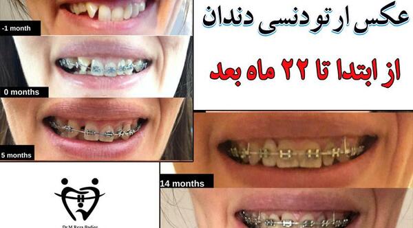 عکس های قبل و بعد از ارتودنسی