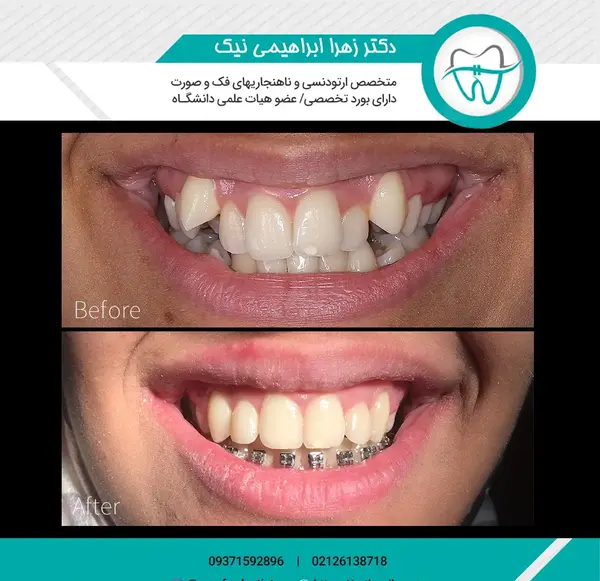 عکس های قبل و بعد از ارتودنسی