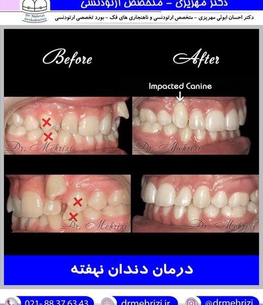عکس های قبل و بعد از ارتودنسی