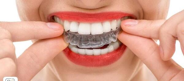عکس های قبل و بعد از ارتودنسی