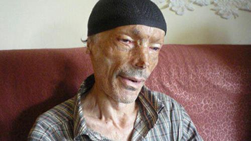 عکس حسن امیدزاده قبل از سوختگی