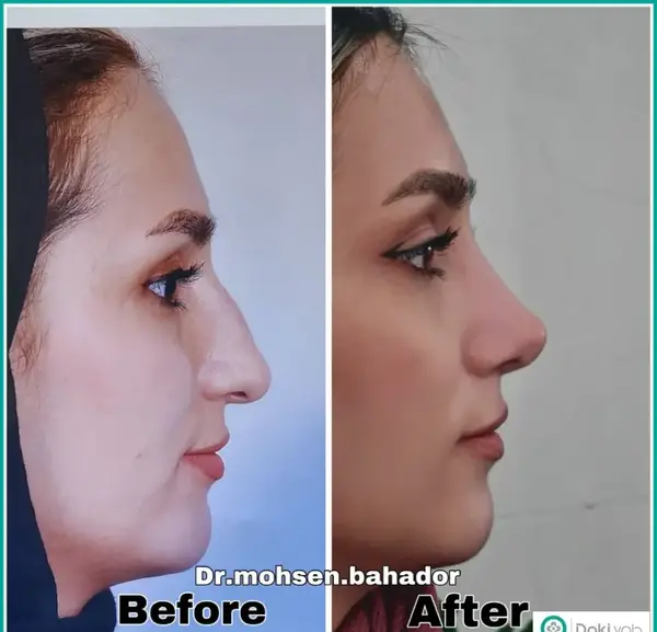 عکس محسن یگانه قبل عمل بینی